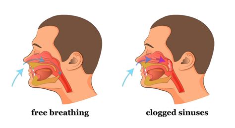 If the body stops producing as much <b>mucus</b>, the sinuses can become dry, leading to a <b>feeling</b> of uncomfortable dryness in the <b>nose</b> and airways. . Nose feels blocked but no mucus